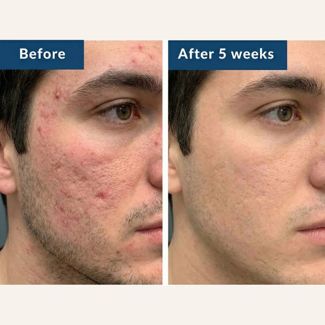Bye Bye Acne Protocol