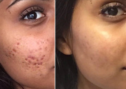 Bye Bye Acne Protocol